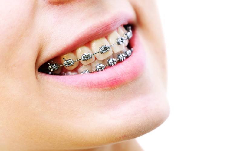هل تقويم الأسنان ممكن للكبار؟