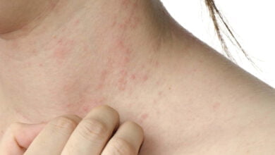 صورة أعراض التهاب الأكزيما والتخلص منها نهائياً