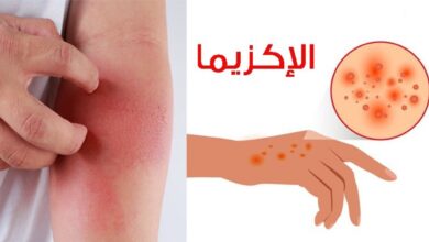 صورة الأكزيما الأعراض والأسباب