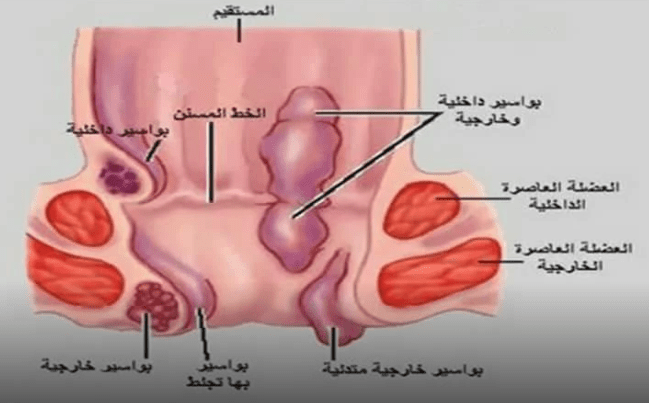 أنواع البواسير: