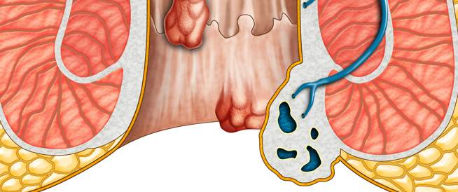 أسباب البواسير الداخلية
