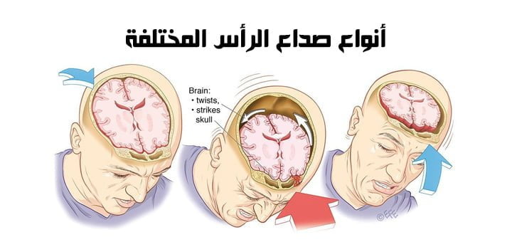 أنواع صداع الرأس المختلفة
