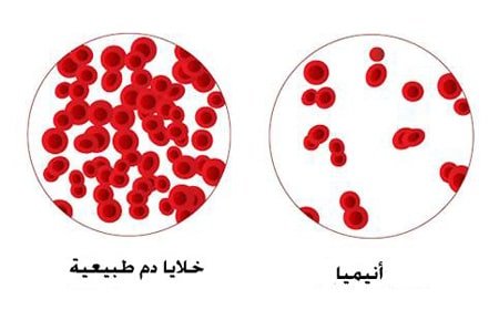 مرض فقر الدم أسبابه وأعراضه