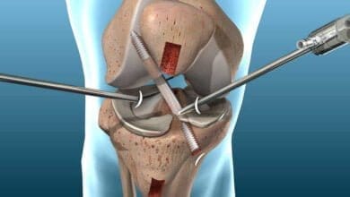 صورة إصابة الرباط الصليبي الأمامي للركبة