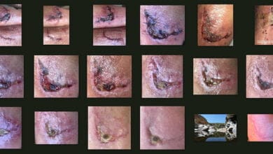 صورة الجروح المزمنة الغير قابلة للإلتئام