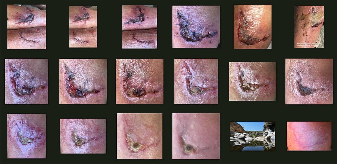 الجروح المزمنة الغير قابلة للإلتئام