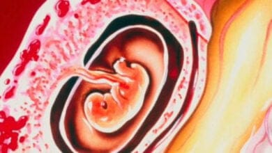 صورة الحمل المنتبذ أو الحمل خارج الرحم (ectopic pregnancy)