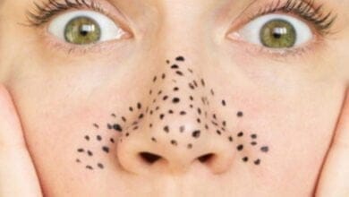 صورة الرؤوس السوداء ليست مشكلة بعد الآن