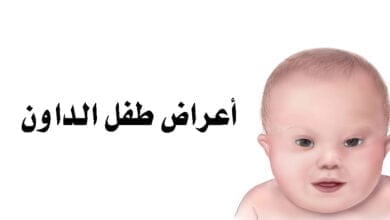 صورة أعراض طفل الداون