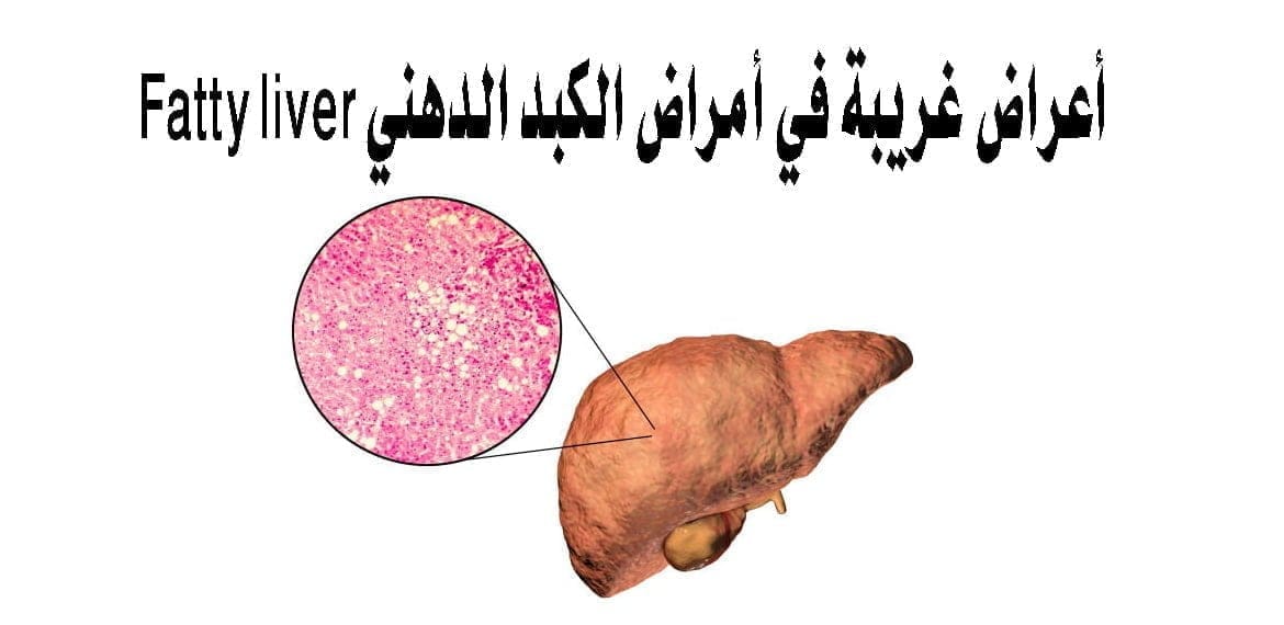 أعراض غريبة في أمراض الكبد الدهني Fatty liver