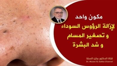 صورة أفضل خلطة لإزالة الرؤوس السوداء