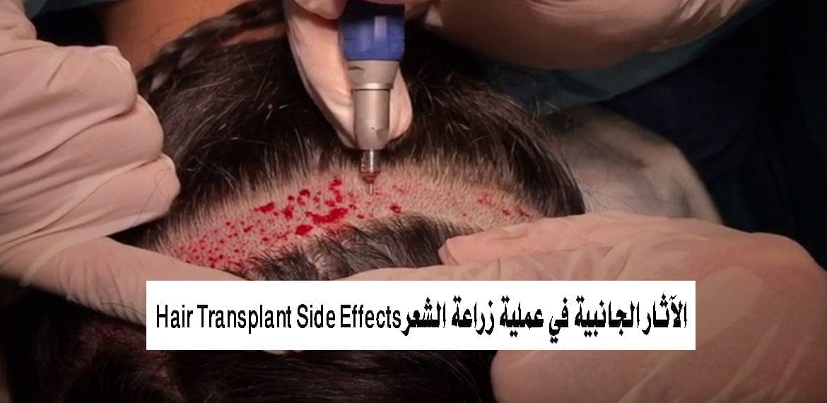 الآثار الجانبية في عملية زراعة الشعر Hair Transplant Side Effects
