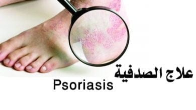صورة الصدفية وعلاجها Psoriasis