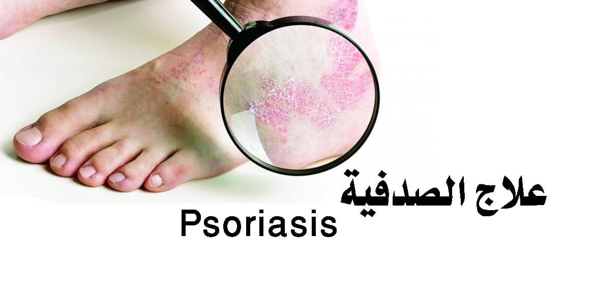 الصدفية وعلاجها Psoriasis