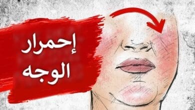 صورة داء الوردية السبب الحقيقي لاحمرار الوجه