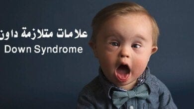 صورة علامات متلازمة داون Down Syndrome