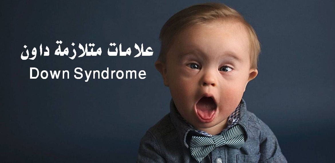 علامات متلازمة داون Down Syndrome