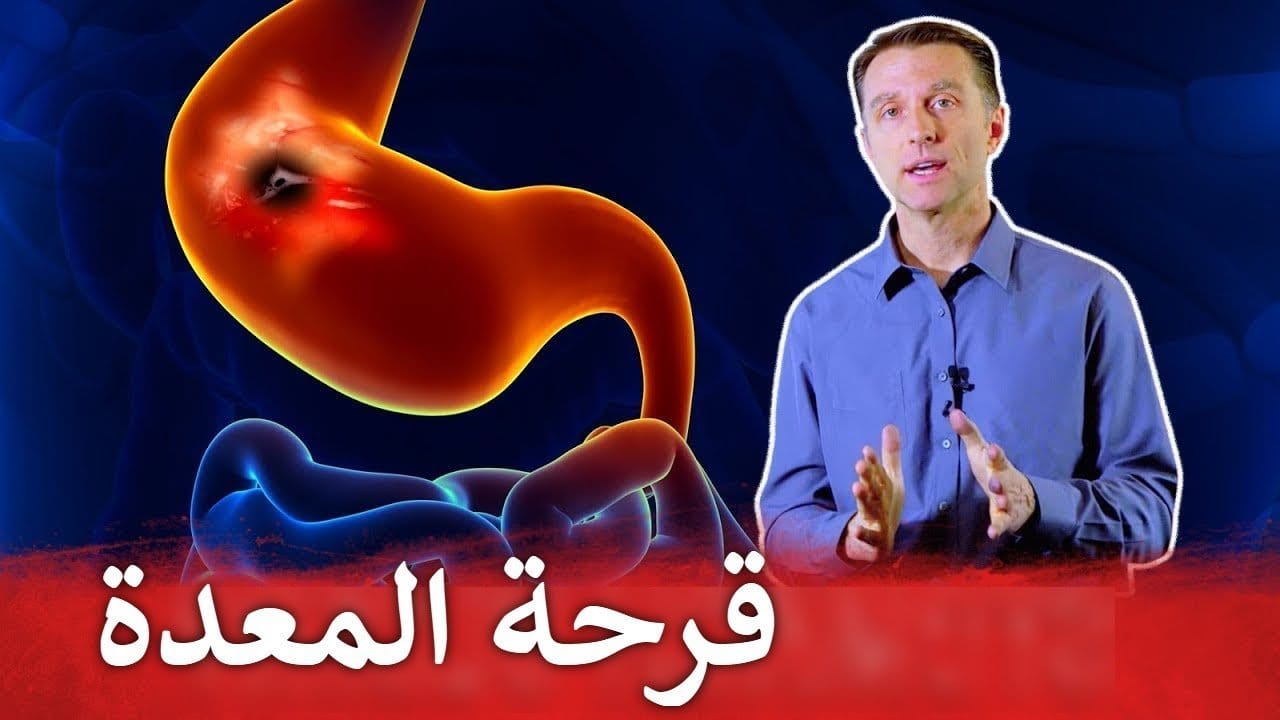 قرحة المعدة الوقاية والعلاج