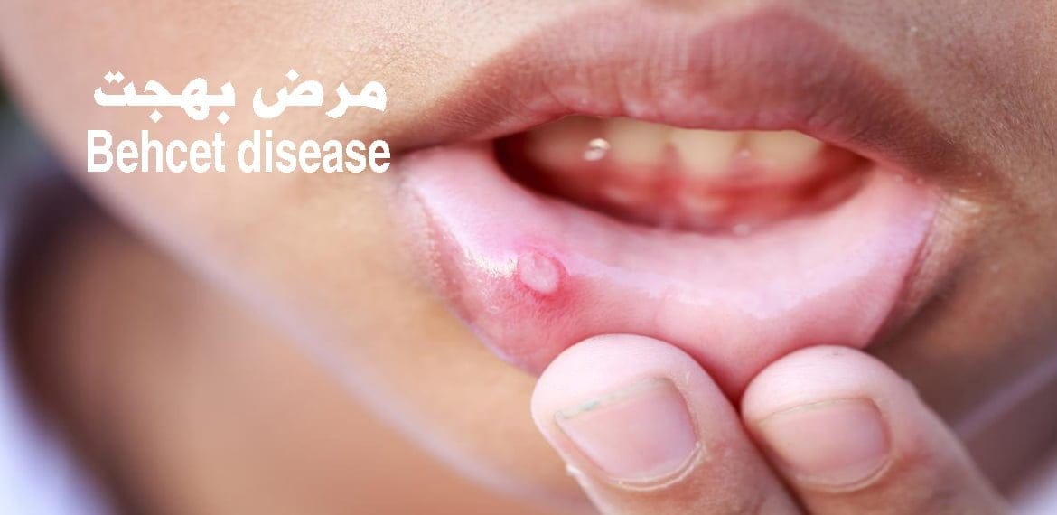ما حقيقة مرض بهجت أو Behcet disease