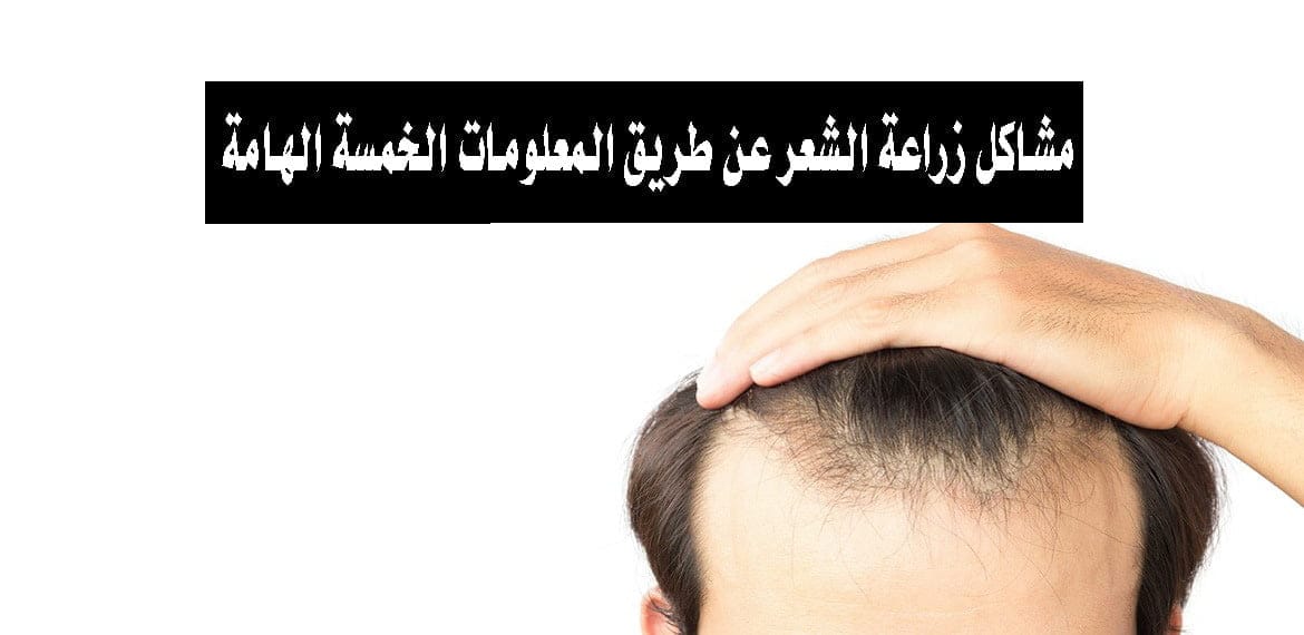 مشاكل زراعة الشعر عن طريق المعلومات الخمسة الهامة