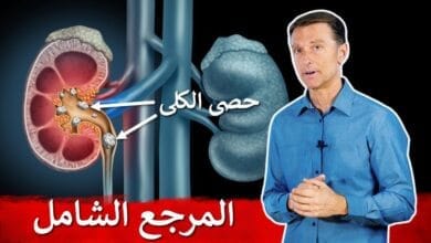صورة نصيحتي لمرضى حصى الكلى دكتور بيرج
