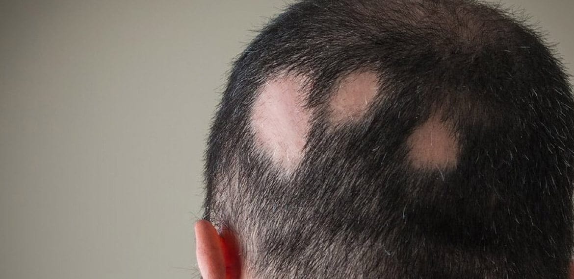 أنواع الثعلبة Alopecia وأسباب وجودها