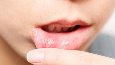 صورة تقرحات الفم أسبابها وعلاجها