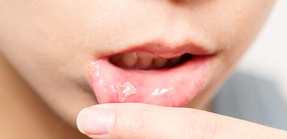 تقرحات الفم أسبابها وعلاجها