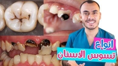 صورة تسوس الأسنان