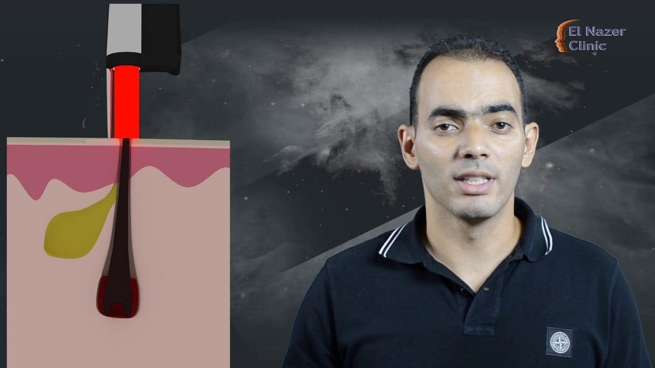 حقيقة إزالة الشعر بالليزر الجزء الأول