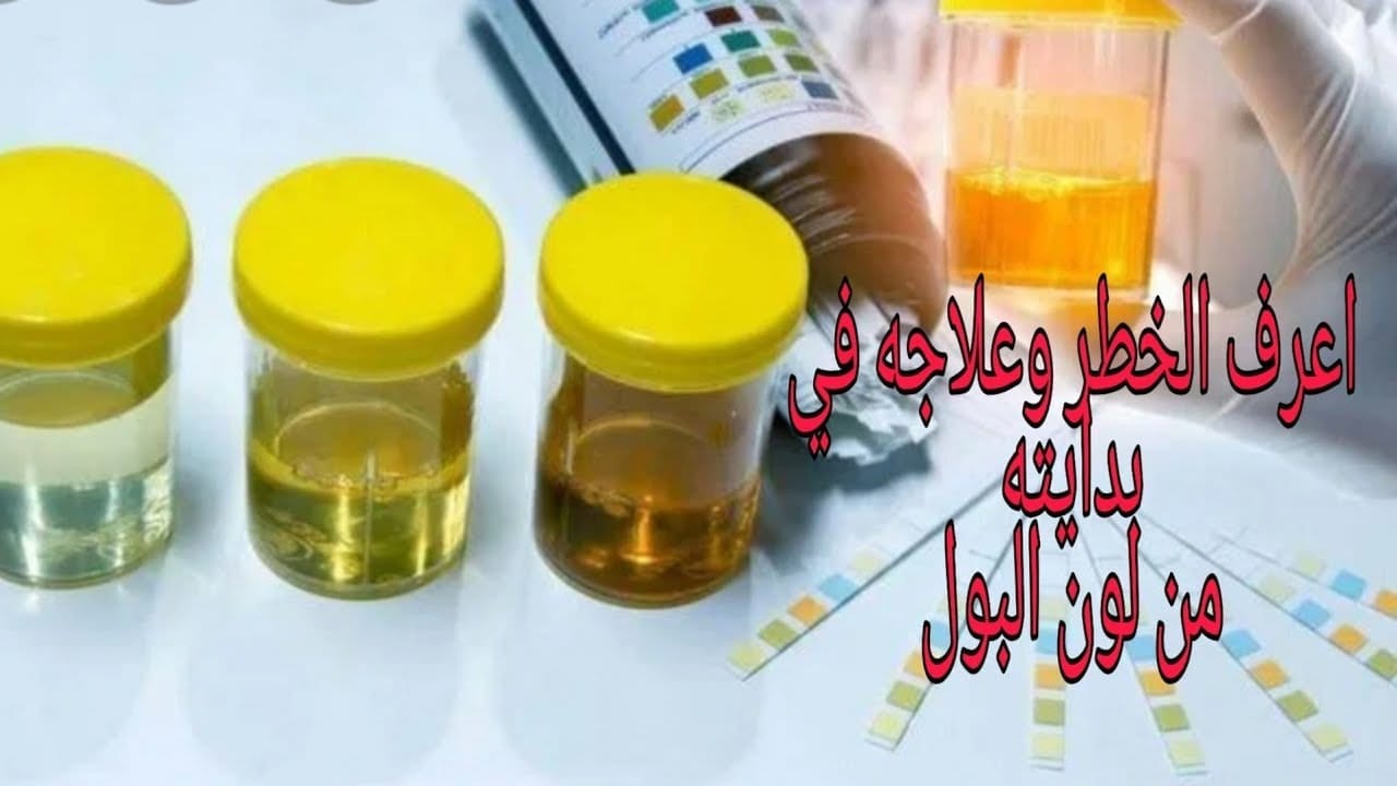 ماذا يخبرك لون البول عن جسمك؟