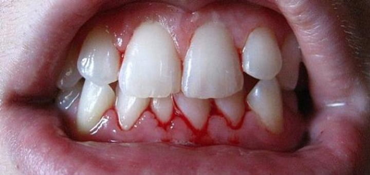 معجون الأسنان لنزيف اللثة