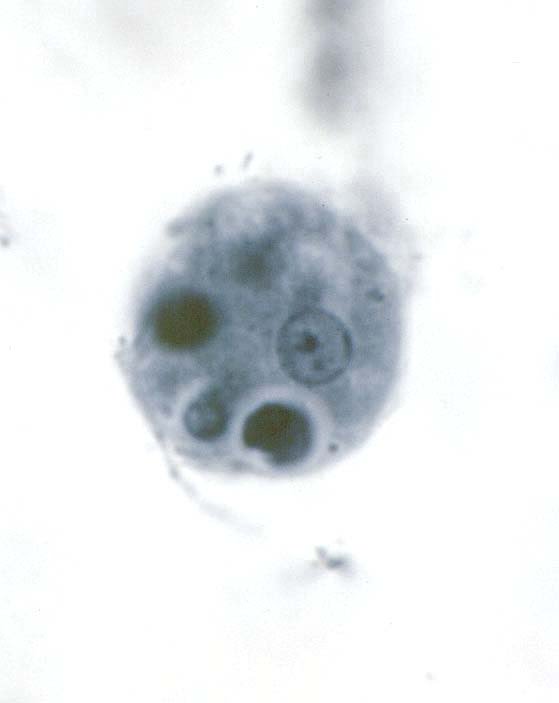 إرفاق صورة Entamoeba Histolytica  (Cyst ) و ( trophozoite )