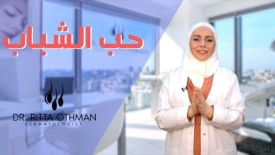 صورة حب الشباب أسبابه وعلاجه