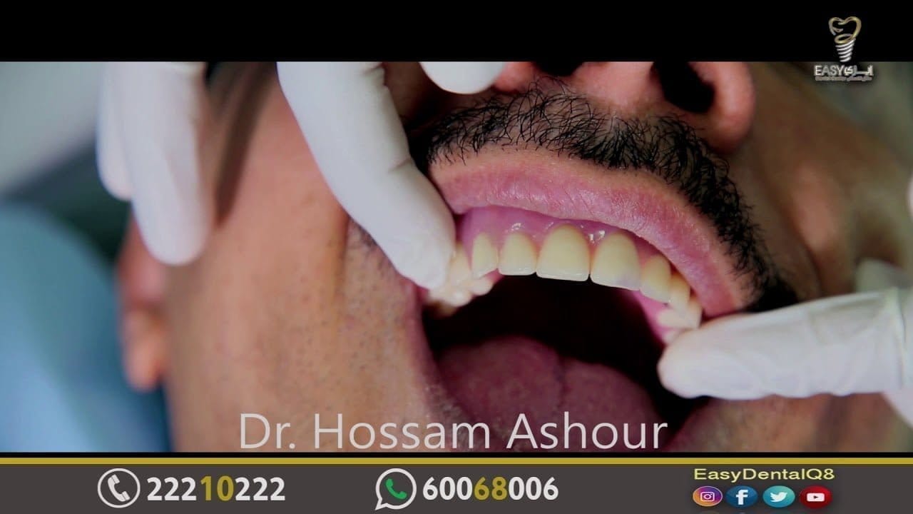 زراعة الأسنان بدون زراعة عظام بطريقة سهلة