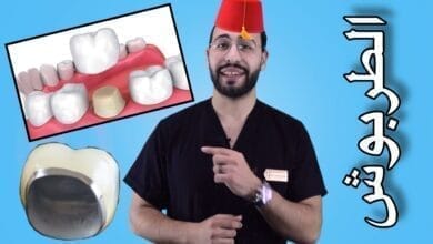 صورة كيف يتم تركيب تلبيس الأسنان والضرس؟