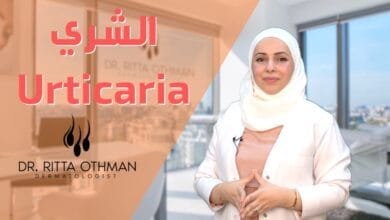 صورة مرض الشري و الحساسية