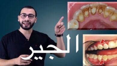 صورة شرح ازالة الجير وتنظيف الأسنان