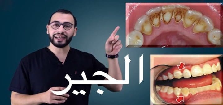 شرح ازالة الجير وتنظيف الأسنان