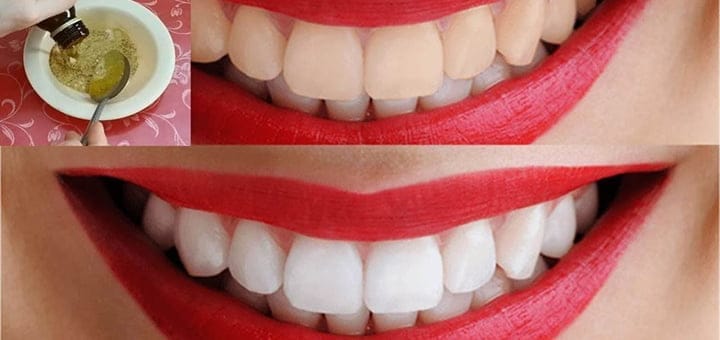 خلطات تبييض الأسنان و 10 طرق سهلة التحضير