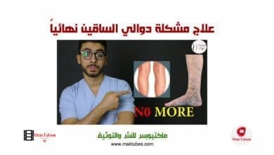 صورة علاج مشكلة دوالي الساقين نهائياً