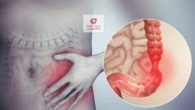 صورة علاج القولون العصبي IBS | ما هي اعراضه | كيف يتم تشخيصه