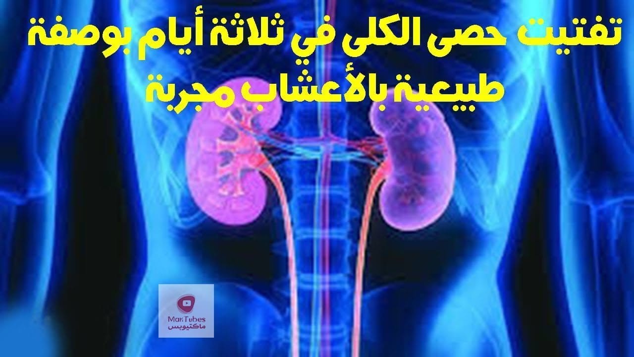 التخلص من حصى الكلى | كيف؟ و ماهي طريقة معالجة حصى الكلى؟