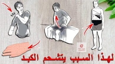 صورة اسباب تشحم الكبد او الكبد الدهني | درجات تشحم الكبد | علاج تشحم الكبد