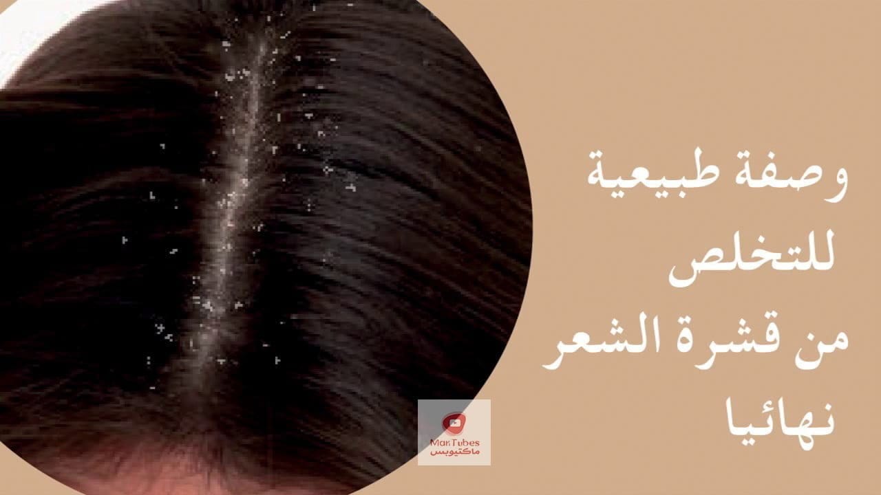 ما الطرق للتخلص من قشرة الراس بسرعة في المنزل وحماية فروة الراس