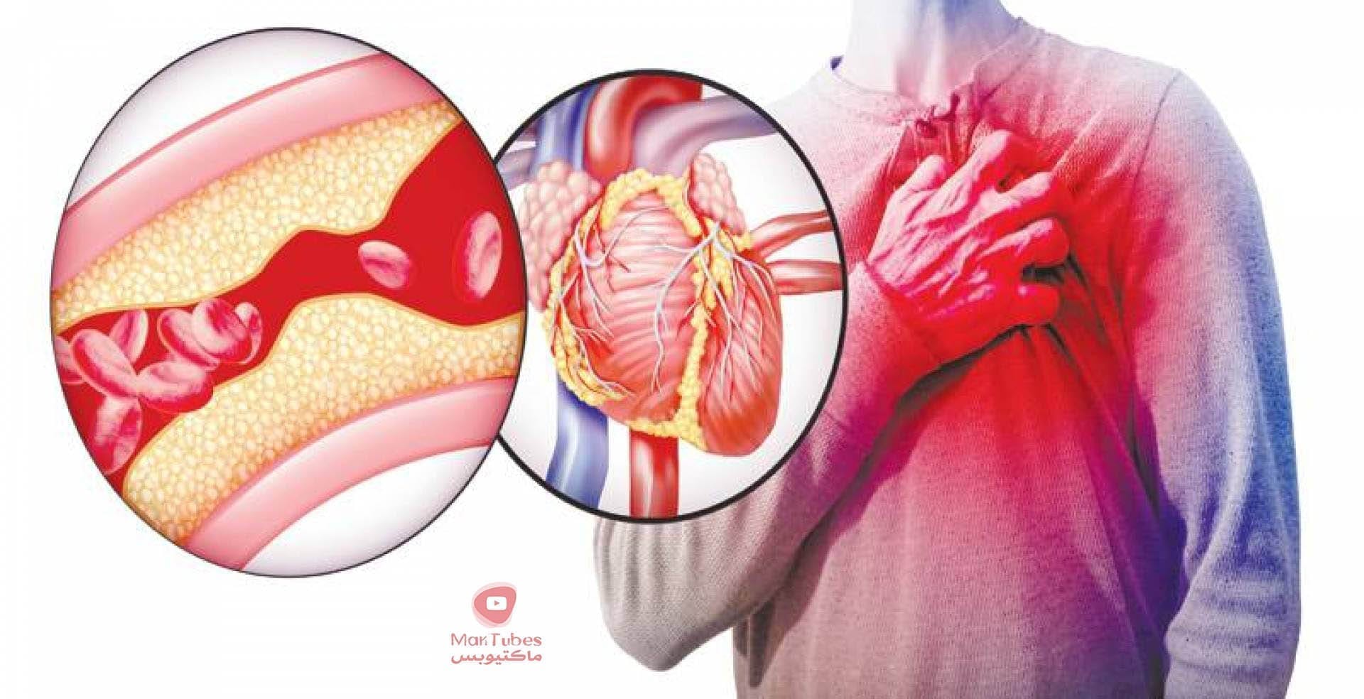 تخثر الدم طريقة لتخفيفه اثناء الصيام واسباب تخثر الدم في الساق والعلاجات المقترحة