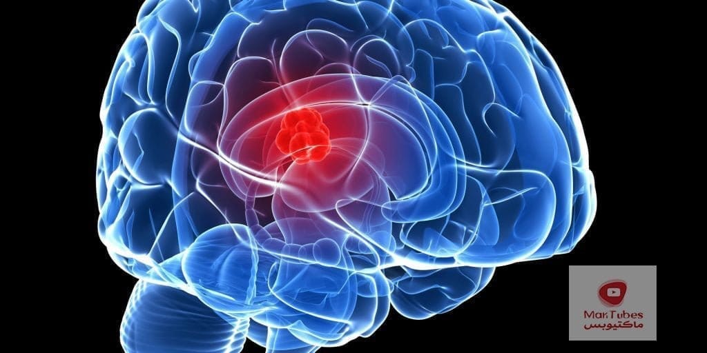 لقاح سرطان الدماغ في القريب العاجل