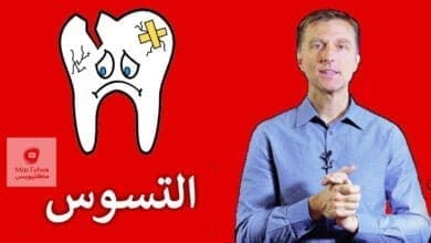 صورة تسوس الاسنان | ما هو سببه و كيف يمكن الوقاية من تسوس الاسنان | للبالغين والاطفال