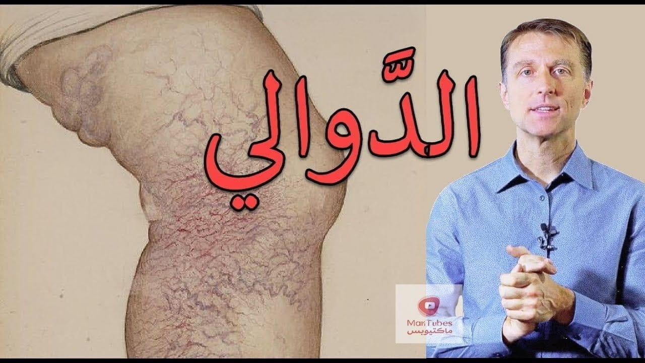 علاج الدوالي و الدوالي السطحية و اسبابها | وهل الادوية العشبية والفيتامينات تجدي نفعا