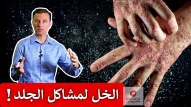 صورة فائدة خل التفاح | استخدموا خل التفاح بهذه الطريقة لمشاكل الجلد والاكزيما